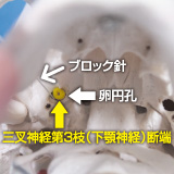 頭蓋底卵円孔の奥にある三叉神経節にブロック針を誘導したイメージ