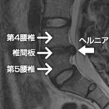 第4・第5腰椎間の椎間板ヘルニア縦断面