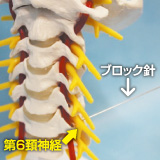 左第6頚神経根ブロックのイメージ